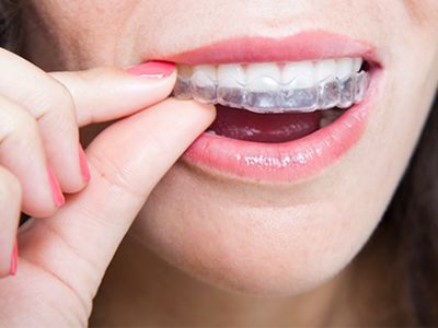 Clear Aligners For Adults